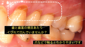 歯ぎしりで歯と歯茎がくびれてきます１