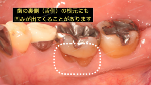 歯ぎしりで歯と歯茎がくびれてきます２