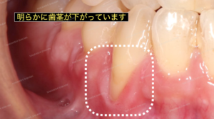 歯ぎしりで歯茎が下げることがあります１