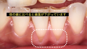 歯ぎしりで歯茎が下げることがあります２