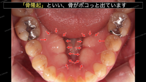 歯ぎしりで骨隆起という骨が出てきます１