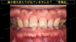 歯ぎしりで骨隆起という骨が出てきます２