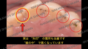 実は隠れ虫歯がある