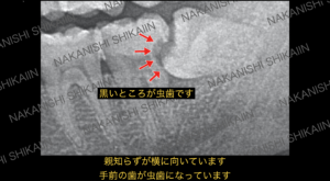 親知らずが横向きに生えており、手前の歯が虫歯になっています。親知らずの抜歯が必要です。