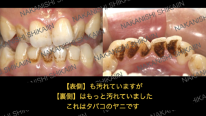 タバコのヤニで歯が汚れている