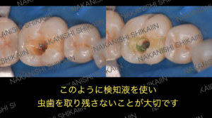 検知液を使い、虫歯を取り残さないことが大切です