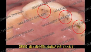歯と歯の間に虫歯ができている