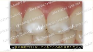 歯の表面が白くなっていることありませんか？