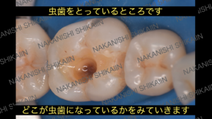 虫歯をとっている途中です　どこが虫歯かみていきます