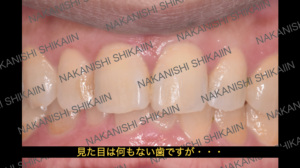 見た目は何もない歯