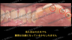 見た目は大丈夫でも裏側は虫歯になっている