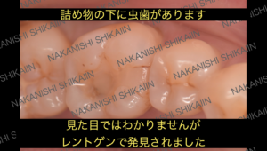 詰め物の下に虫歯がありました　レントゲンで発見されました