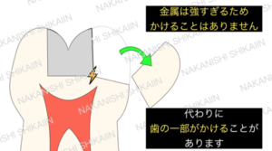 金属は強すぎるためかけませんが、代わりに歯がかけることがあります