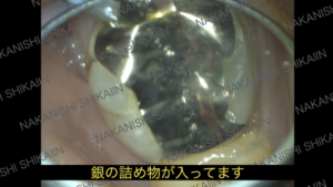 銀の詰め物が入ってます