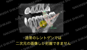 CT画像の断層選択