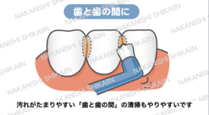 ワンタフトブラシは歯と歯の間の汚れを取りやすいです