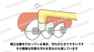 ワンタフトブラシは矯正中の清掃に良い