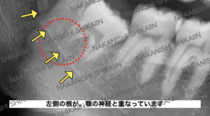 親知らずの抜歯について。左側の根が、顎の神経と重なっています