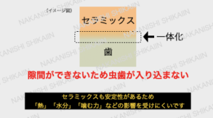 セラミックスは歯と一体化するため、虫歯が入り込む隙間がない