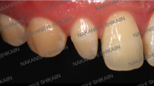 審美セラミックス治療で歯の形を変えられる