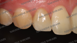 審美セラミックス治療で歯の形を変えられる２