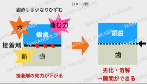 温度変化や噛む力で接着剤が劣化し、剥がれます