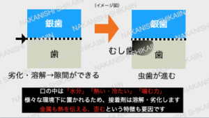 温度変化や噛む力で接着剤が劣化し、剥がれ、隙間から虫歯ができます