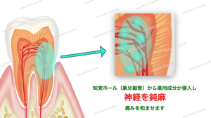 知覚過敏の治療法・知覚ホール（象牙細管）から神経を鈍麻させる
