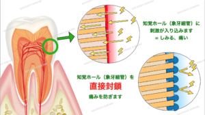 知覚過敏の治療法として知覚ホール（象牙細管）を封鎖する