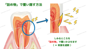 知覚過敏の治療法・詰め物（樹脂プラスチック）で覆い隠す