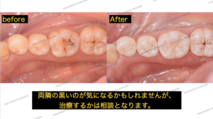 治療前・治療後です。両隣の黒い点が気になるかもしれませんが、治療するか経過観察していくかは患者様と相談となります
