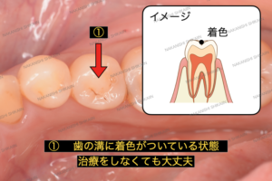 初期虫歯、黒い点は虫歯かと気になるかもしれませんが、歯の溝に着色がある状態です