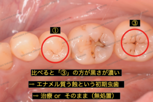 ③は①に比べると濃い黒さです。これはエナメル質う蝕という初発の虫歯です。治療か無処置か、相談の上決定となります。