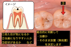 初期虫歯の黒い点は、見た目が気になるか、虫歯になりやすい人か、症状があるかなどで判断していきます