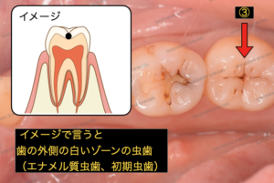 黒い点は初期の虫歯で、歯の外側に限局した初期虫歯です。