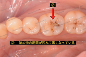 詰め物の周囲が汚れて黒くなっています