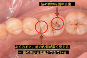 歯の内側が黒く見えており、歯の間から虫歯ができています