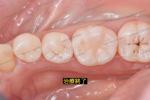 治療が終わった状態です。詰め物をしました