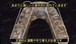 歯ぎしりが激しいとマウスピースが削れていきます