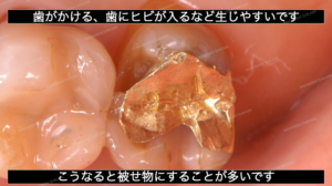 歯ぎしりや噛む力で歯が破折、割れることがあります２