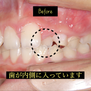 永久歯が１本内側に位置しています。本来なら上の前歯は下の前歯より外側に位置しないといけません。