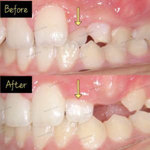 歯が内側に入っている交叉咬合・部分的な反対咬合になっているのを小児矯正で治療しています