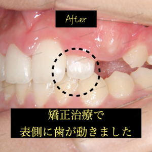 矯正治療によって前歯が表側に移動し、反対咬合・交叉咬合が改善しました。
