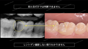 見た目では分からない虫歯もレントゲン撮影をすることで見分けられます