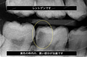 見た目では分からない虫歯もレントゲン撮影をするとはっきりと見分けられます