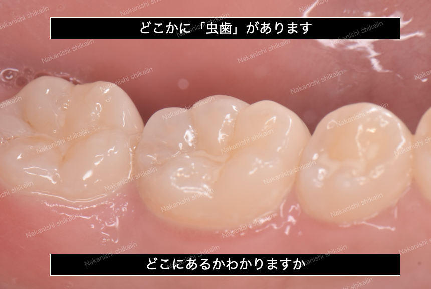ブログ｜津市久居の歯医者｜ナカニシ歯科医院