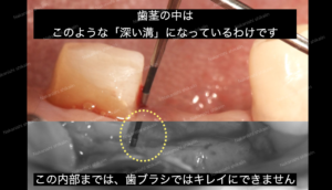 歯周病の歯周外科治療で、歯周ポケットの状態がはっきりわかります。見た目以上に進行していることがあります。