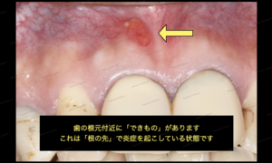 歯茎の白い出来物の腫れの治し方　外科治療・歯根端切除