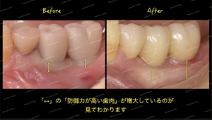 歯肉移植の術前術後です。はっきりと歯肉が違うのがわかります。