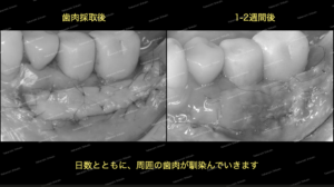 歯肉移植の経過、術前と術後です。周囲歯肉と馴染んでいっているのがわかります。
